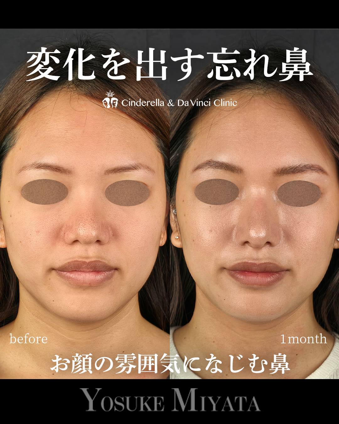 ナチュラルな忘れ鼻の画像