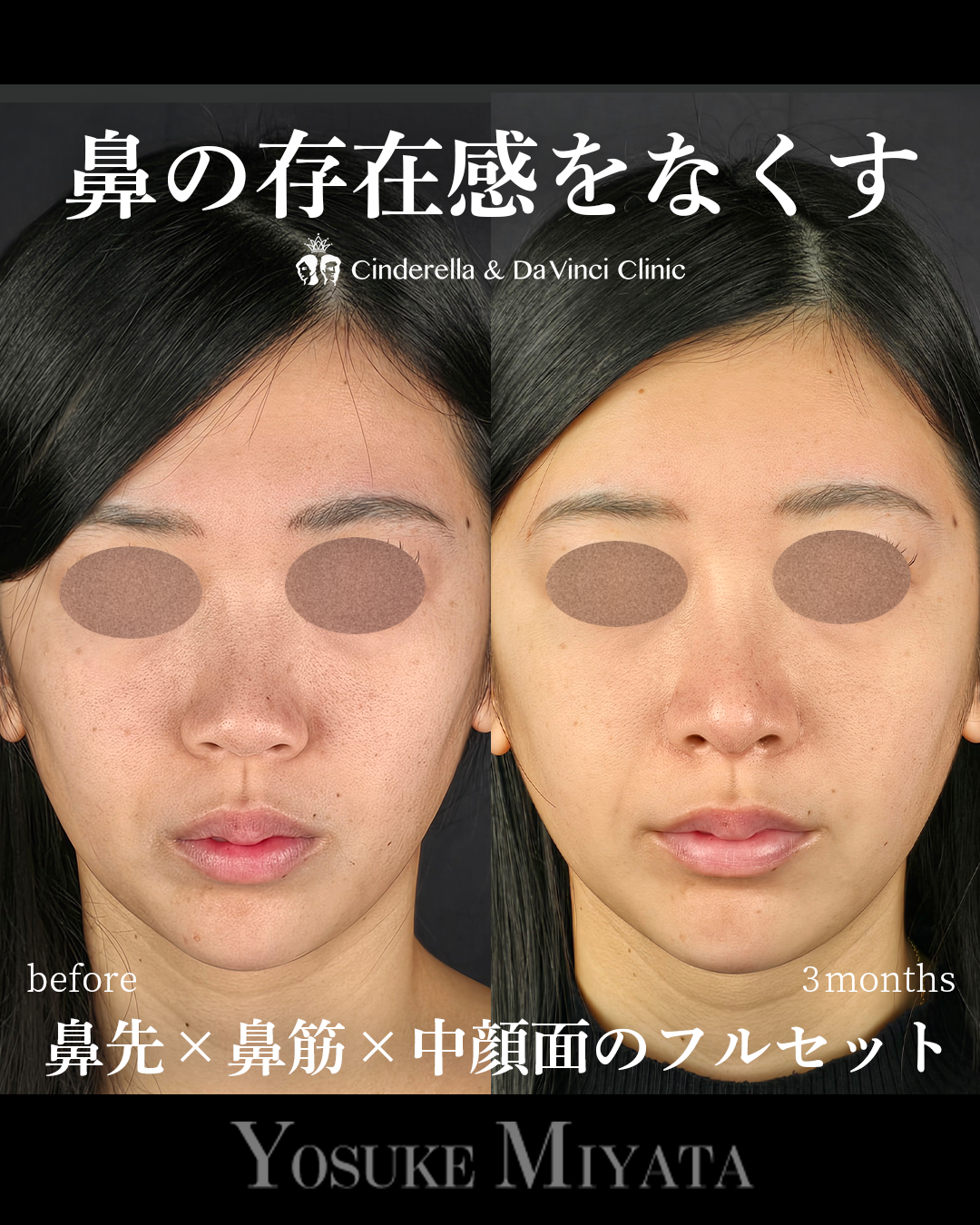 鼻の存在感をなくす