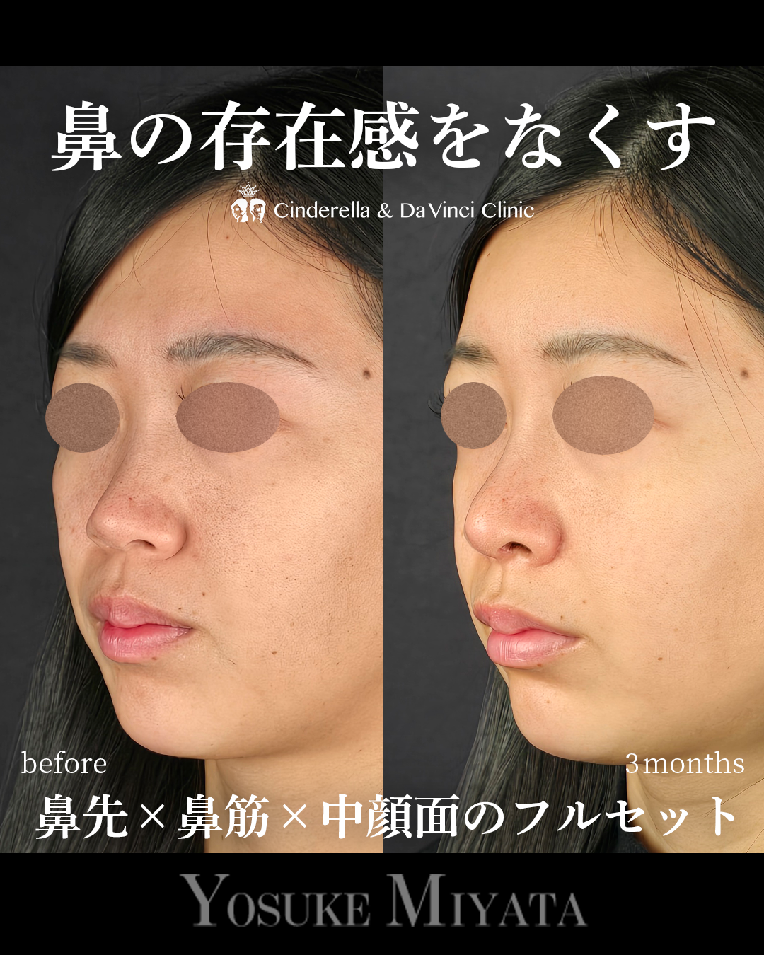 鼻の存在感をなくすの画像