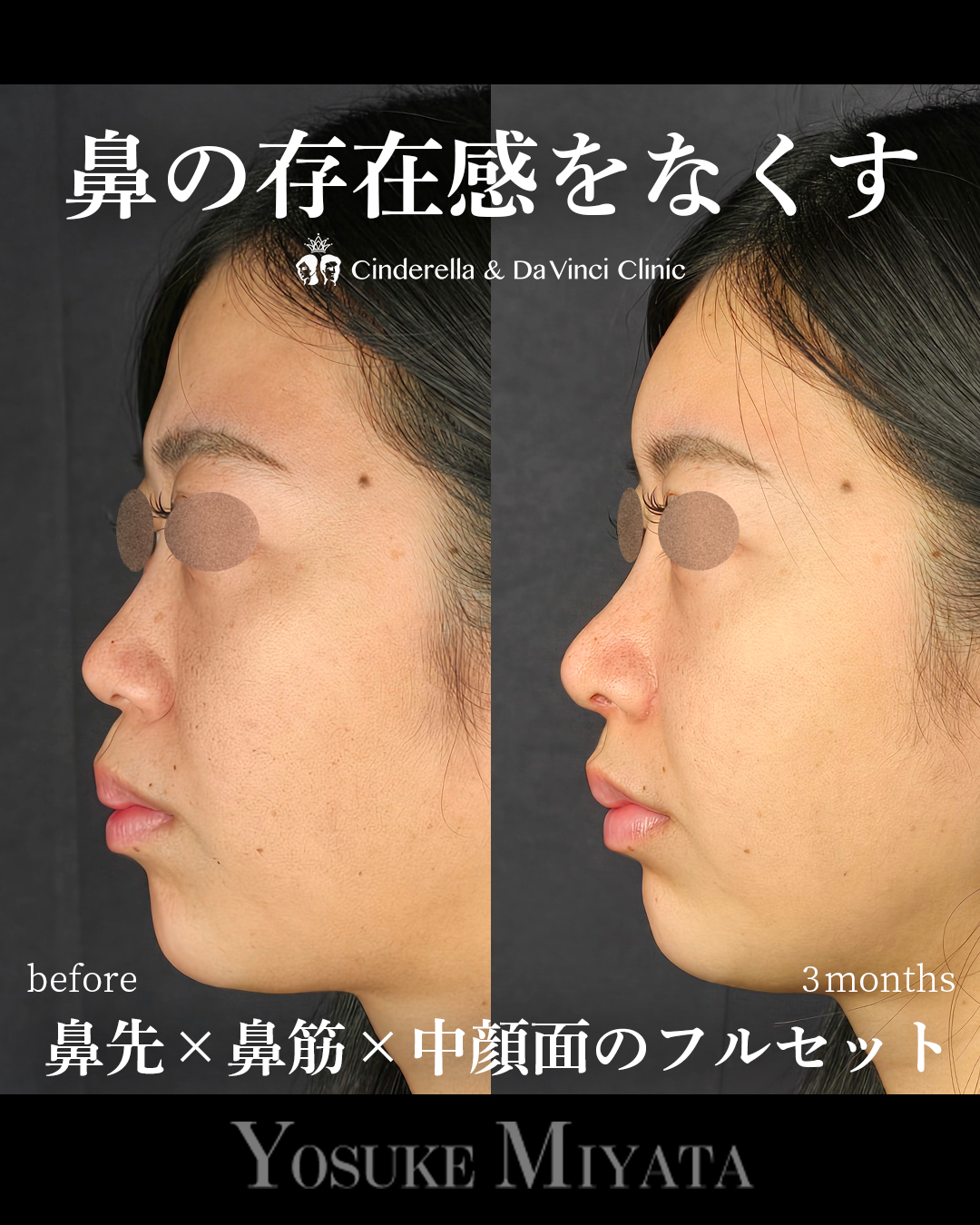 鼻の存在感をなくすの画像