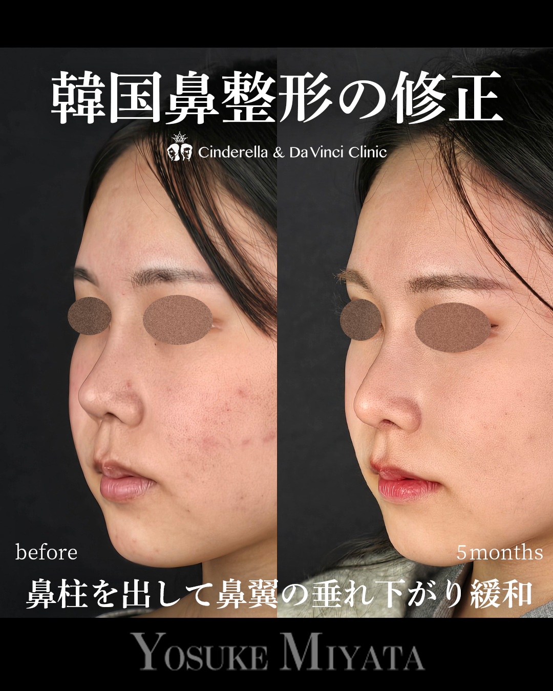 韓国鼻整形の修正の画像