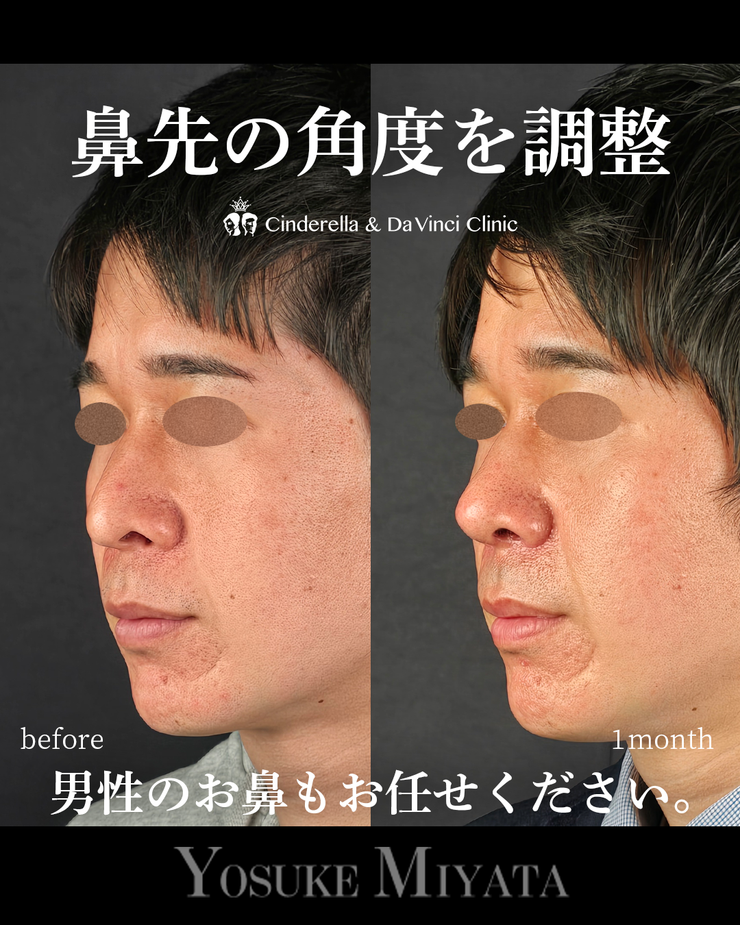 鼻先をツンとさせるの画像