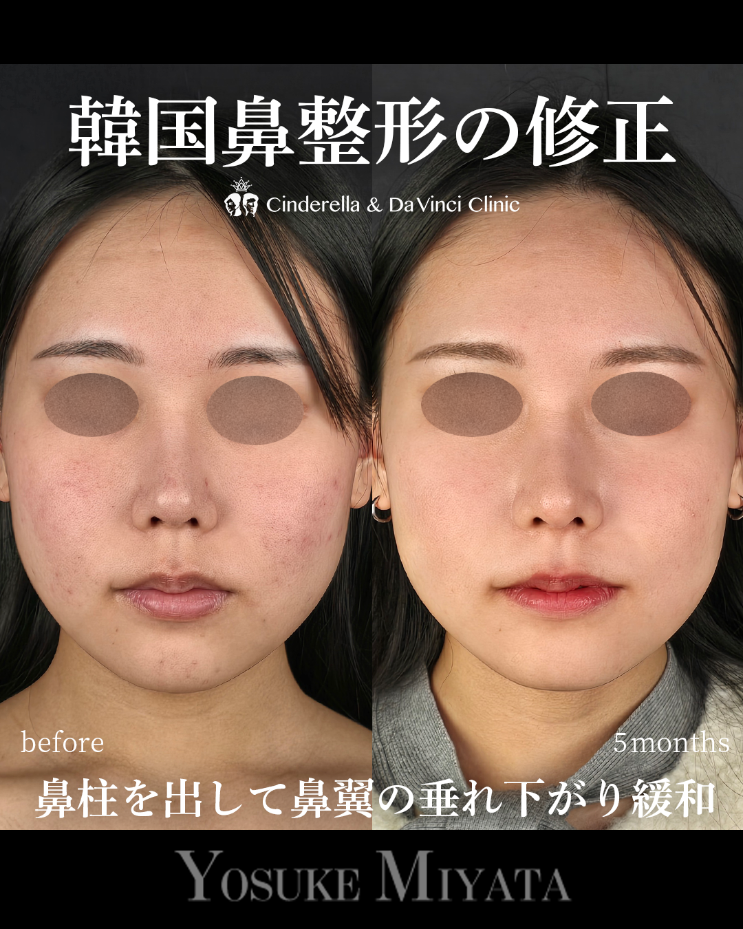 韓国鼻整形の修正の画像
