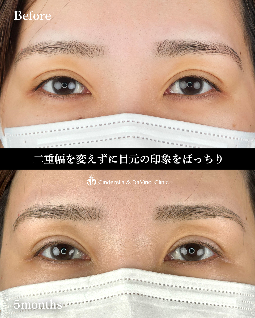 埋没から二重切開への画像