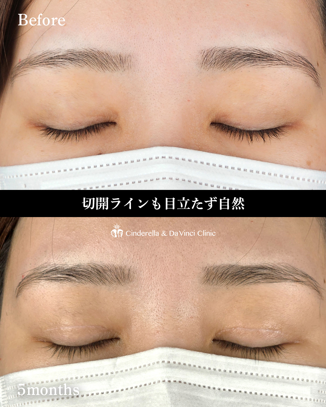 埋没から二重切開への画像