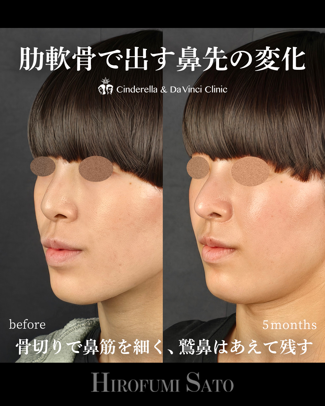 鷲鼻を残した鼻整形の画像