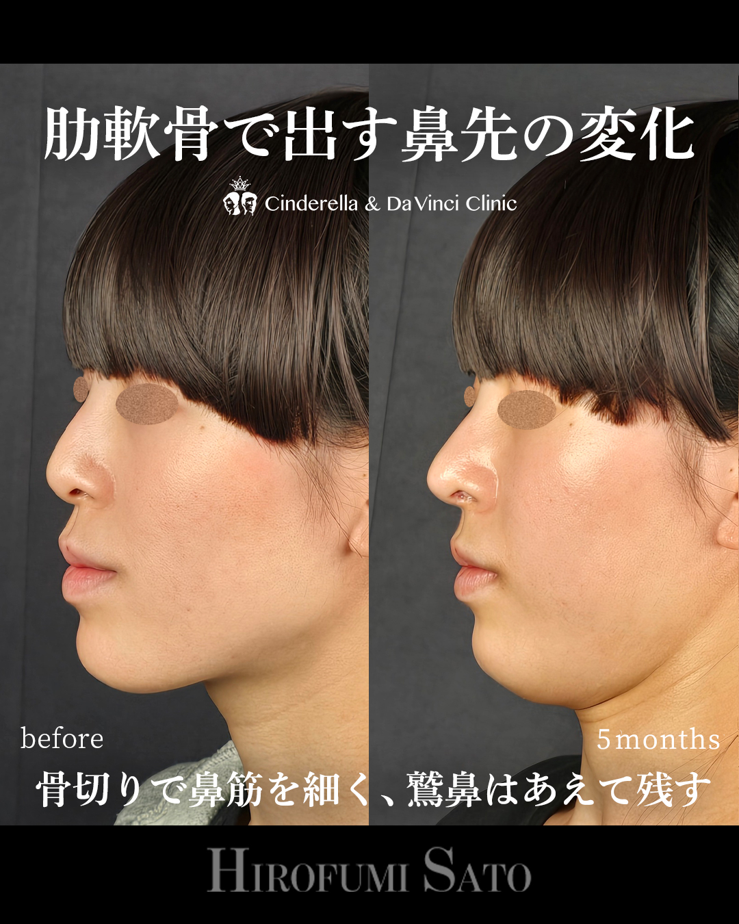 鷲鼻を残した鼻整形の画像