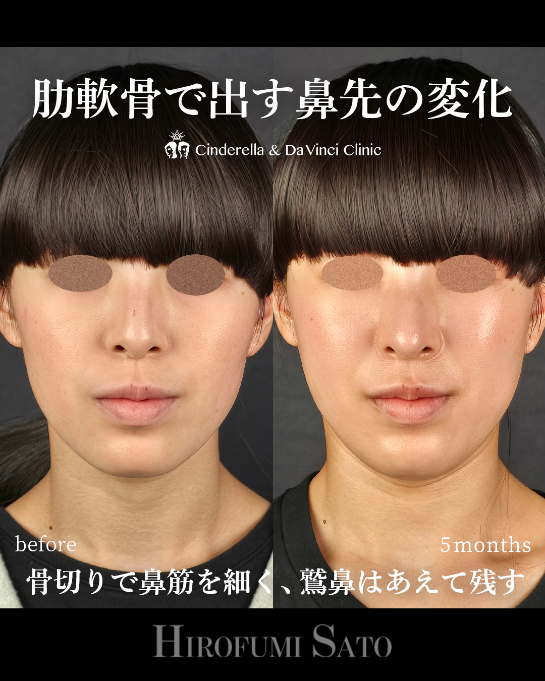 鷲鼻を残した鼻整形の画像