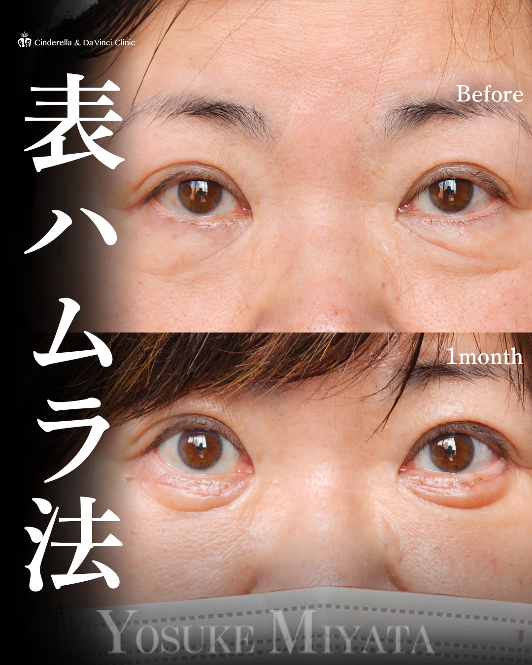 表ハムラで目元スッキリ