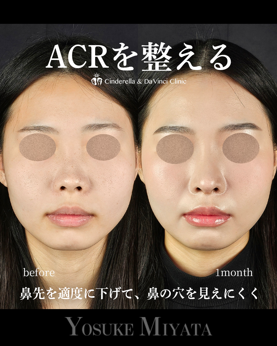 ACRを整える