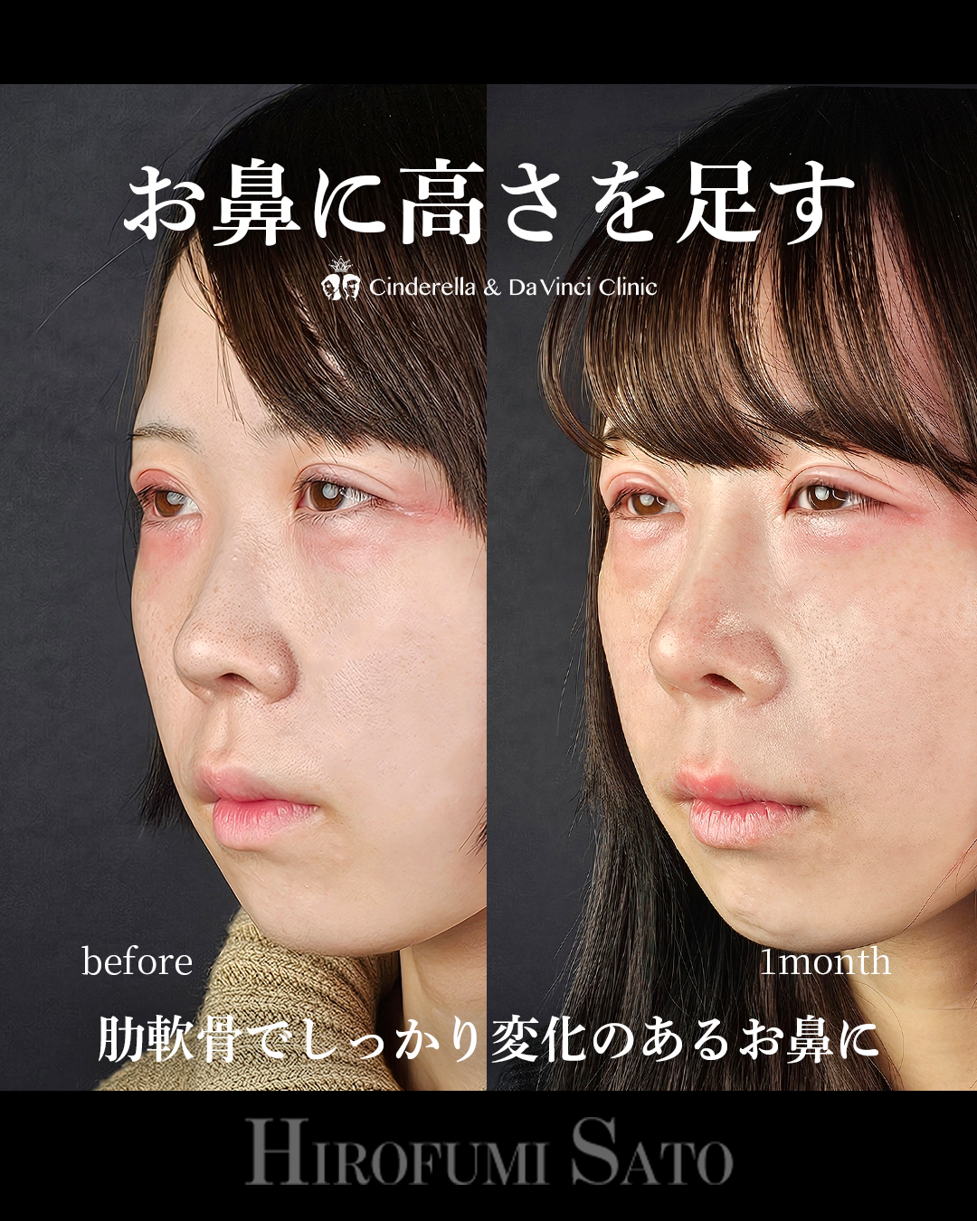 鼻に高さを足す