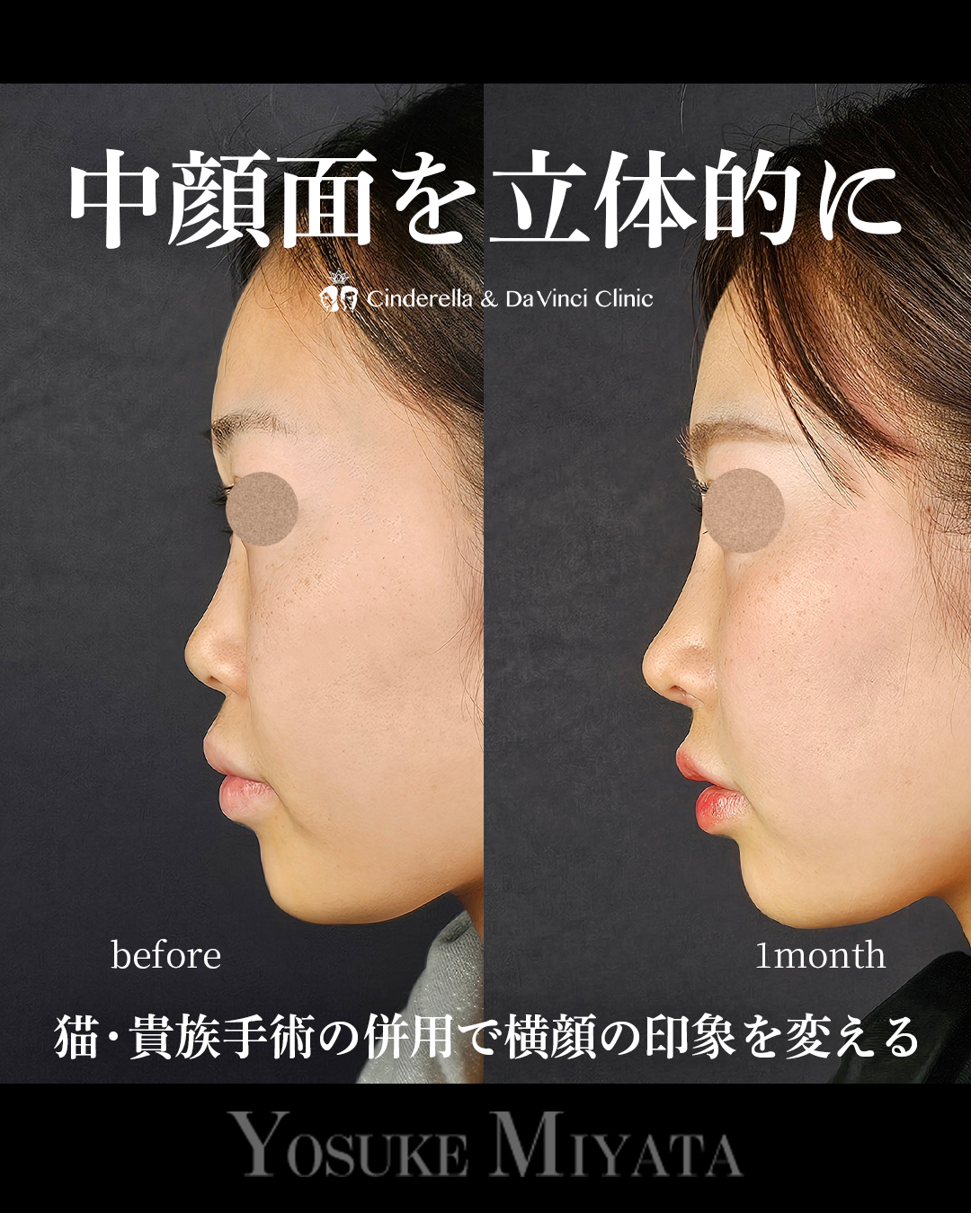 中顔面を立体的に