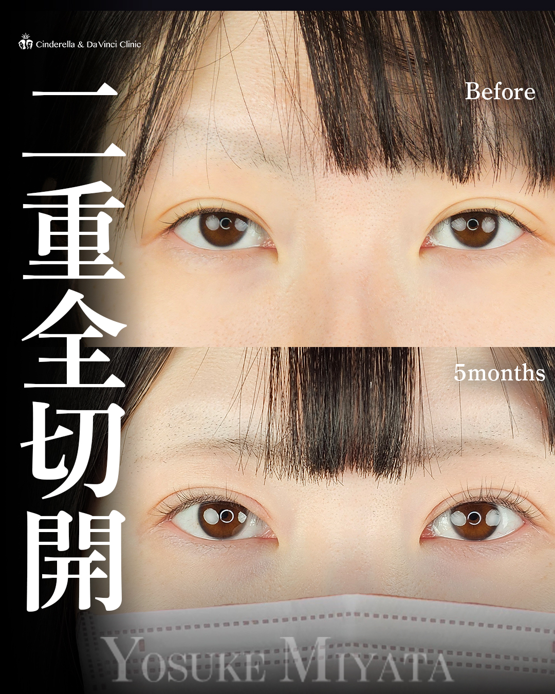 全切開法で華やか二重の画像