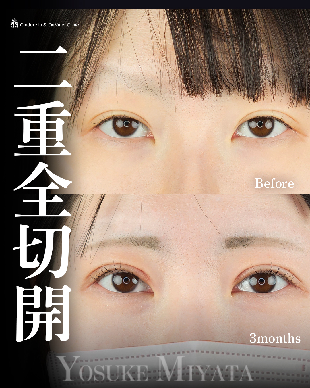 全切開法で華やか二重