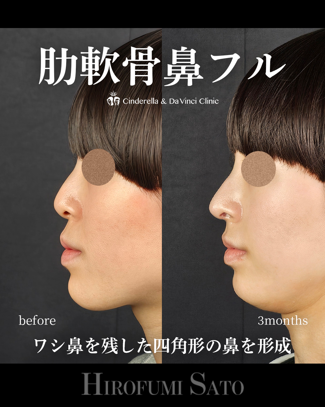 鷲鼻を残した鼻整形の画像