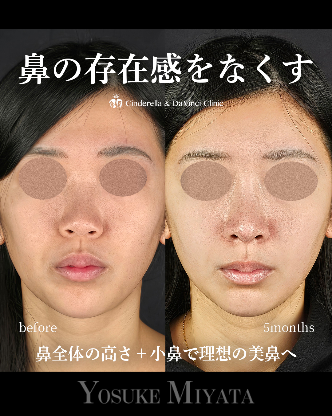 鼻の存在感をなくすの画像