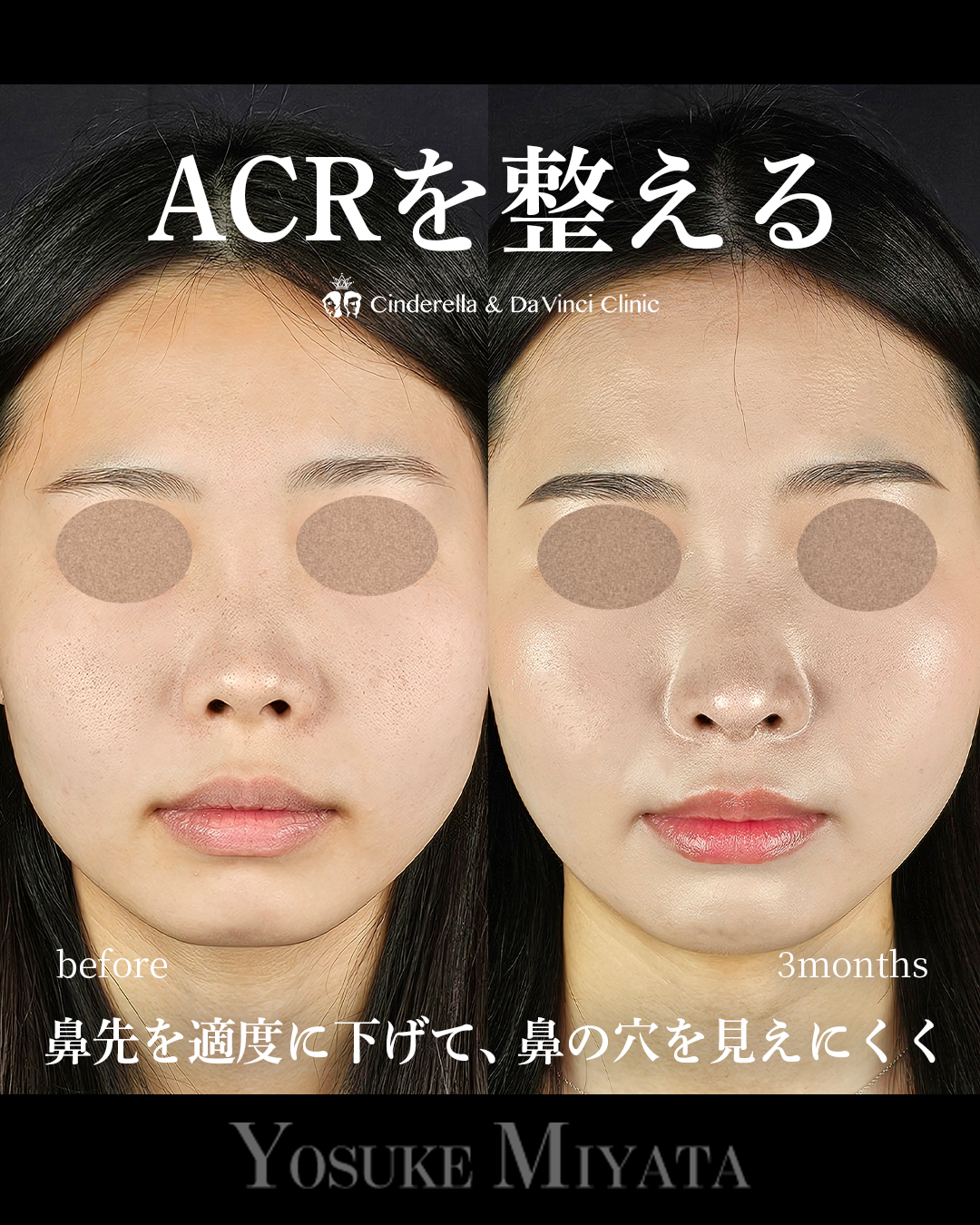 ACRを整えるの画像