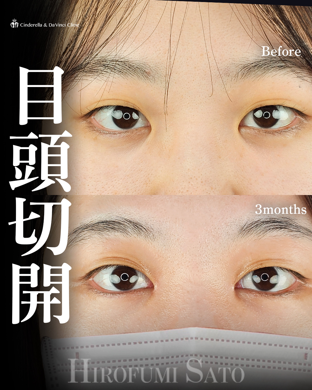 目頭切開のみの画像