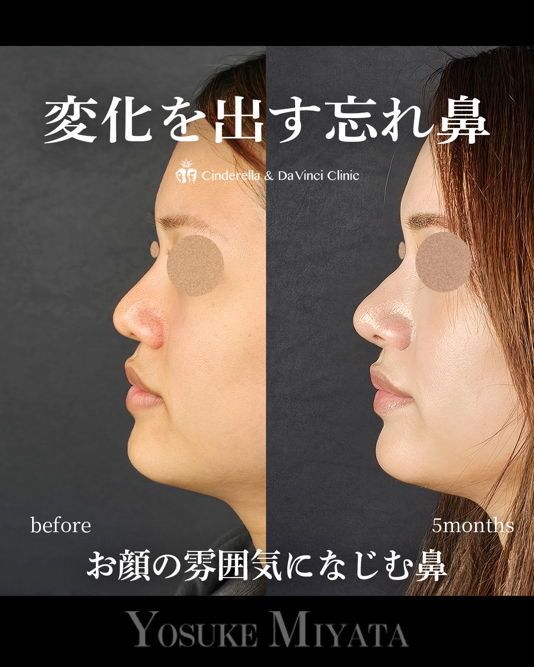 ナチュラルな忘れ鼻の画像