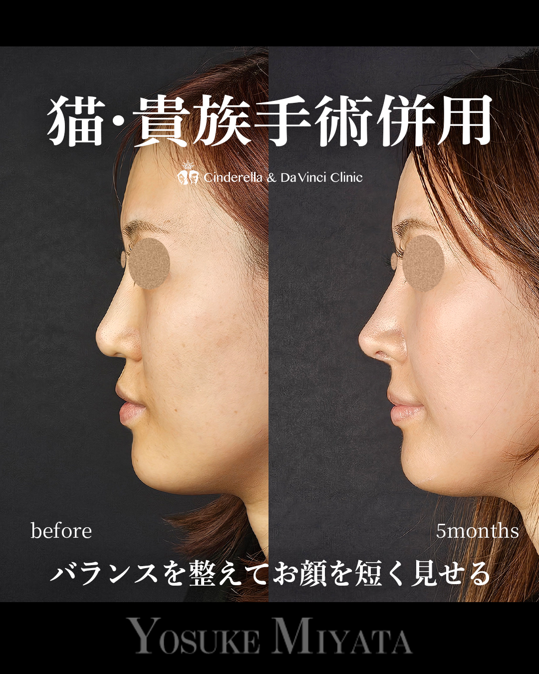 鼻整形で面長改善の画像