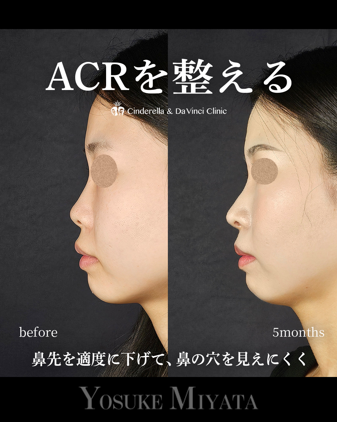 ACRを整えるの画像
