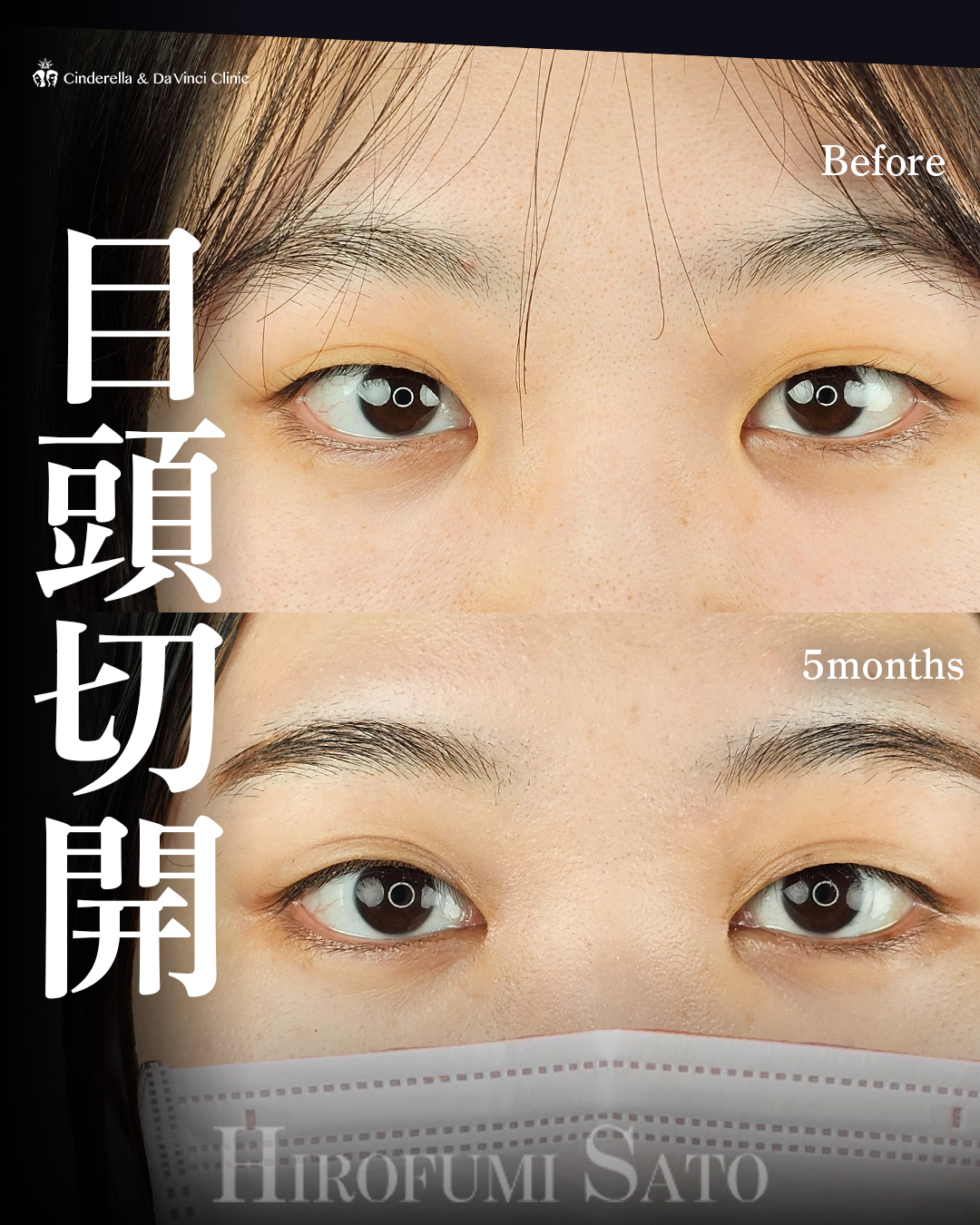 目頭切開のみの画像
