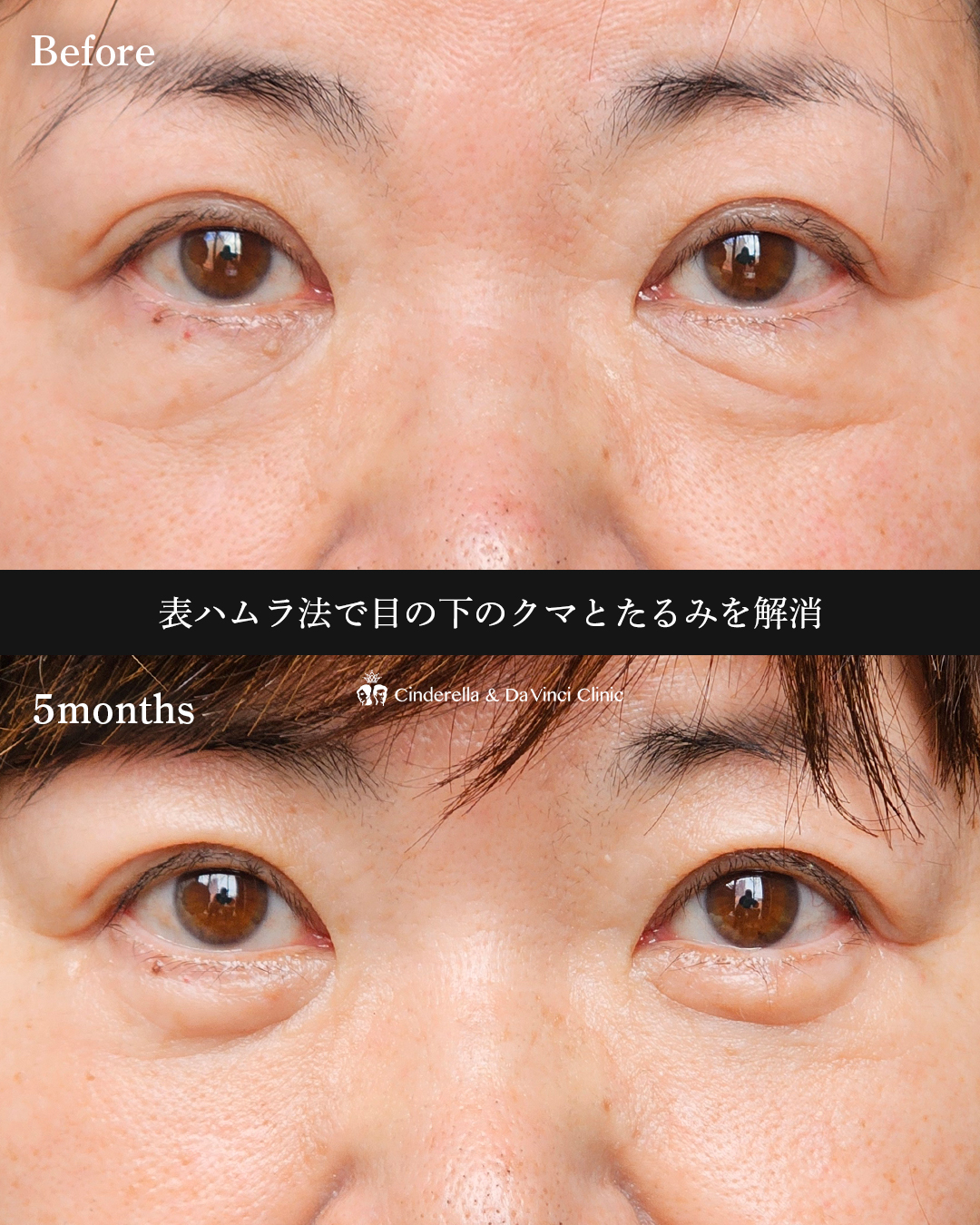 表ハムラで目元スッキリの画像