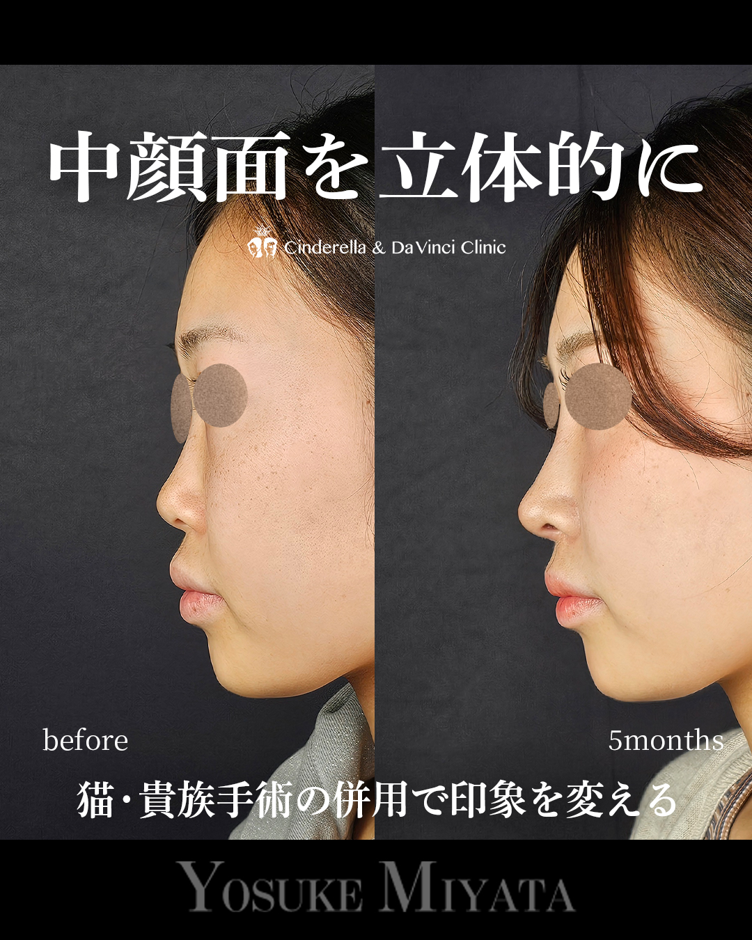 中顔面を立体的にの画像