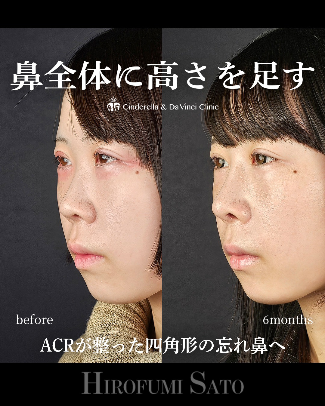 鼻に高さを足すの画像