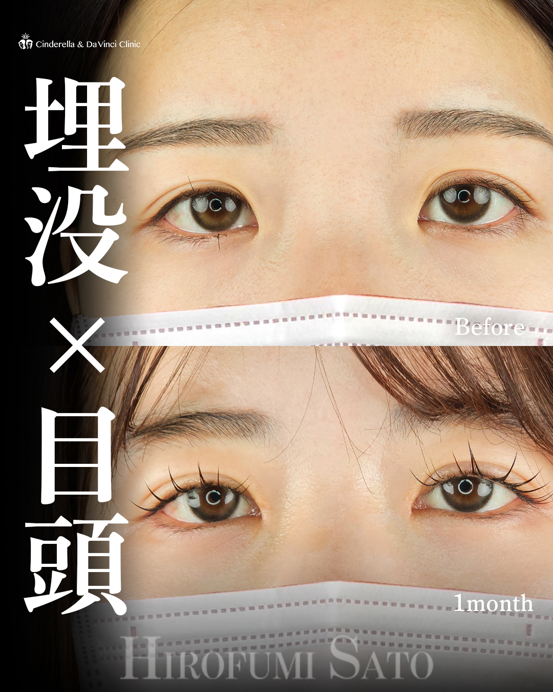 自然癒着法×目頭