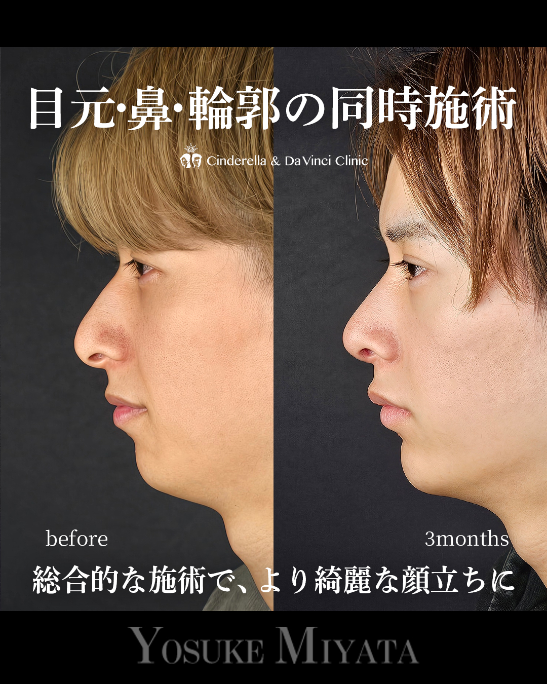 お顔全体アプデ