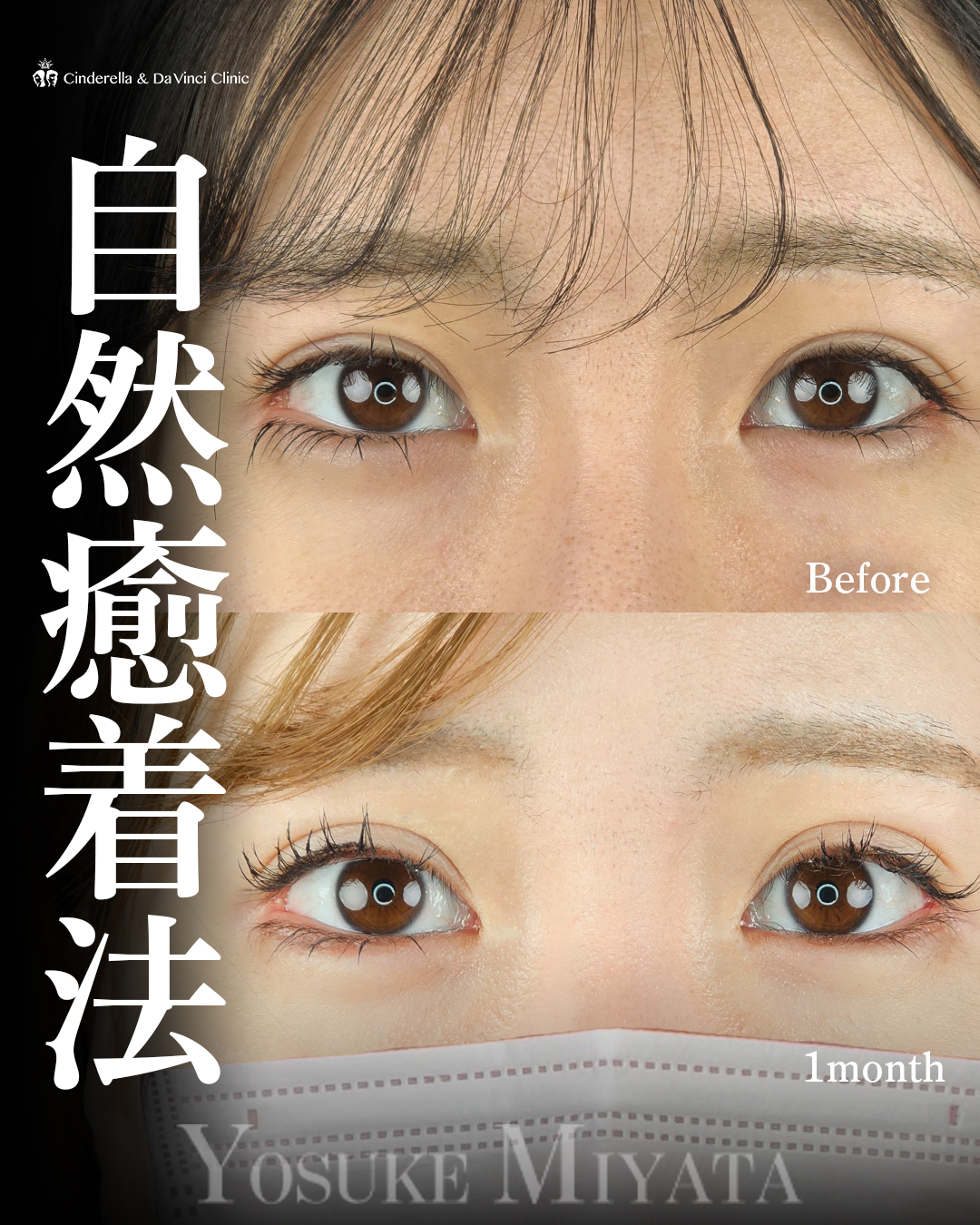 他院埋没の修正