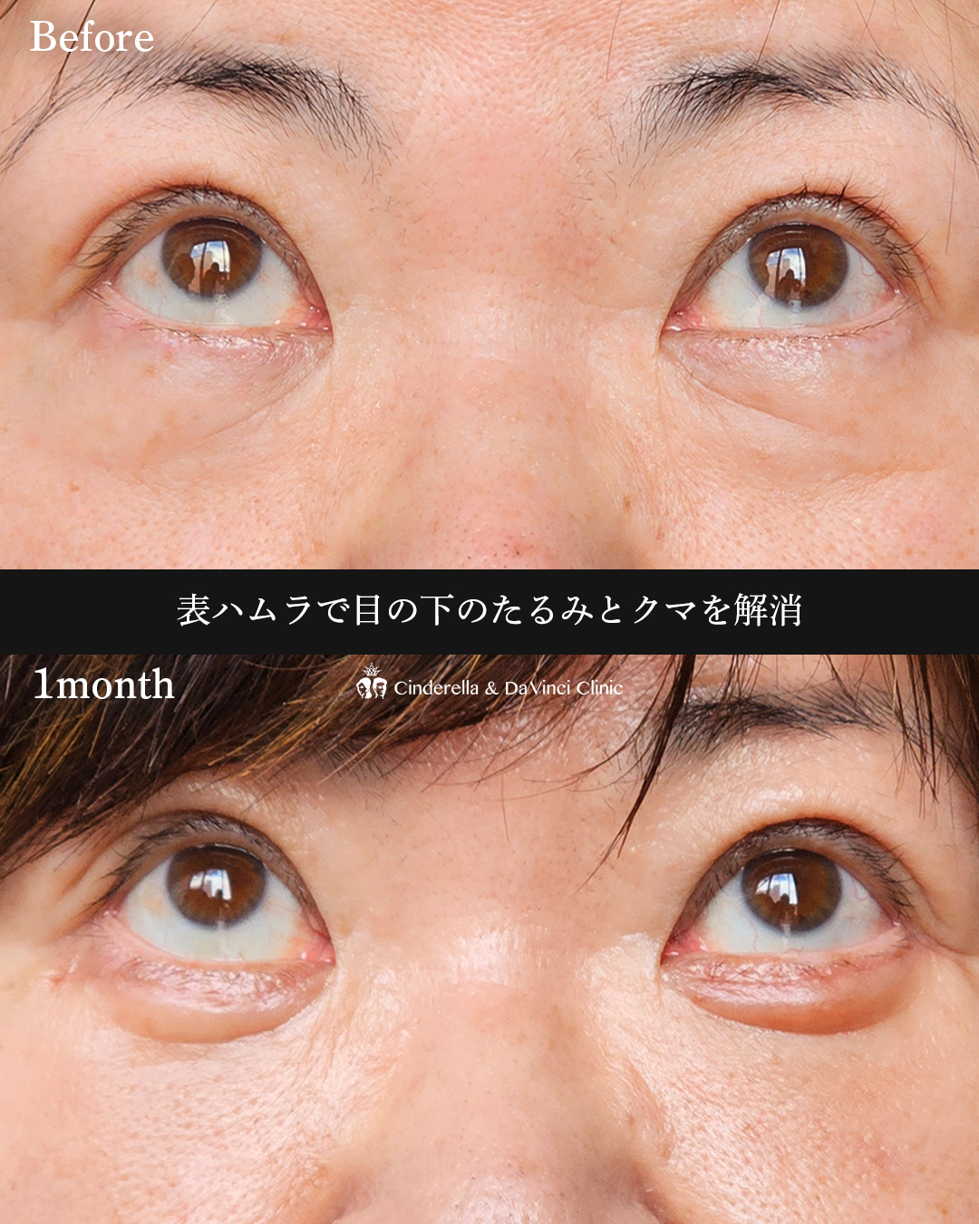 表ハムラで目元スッキリの画像