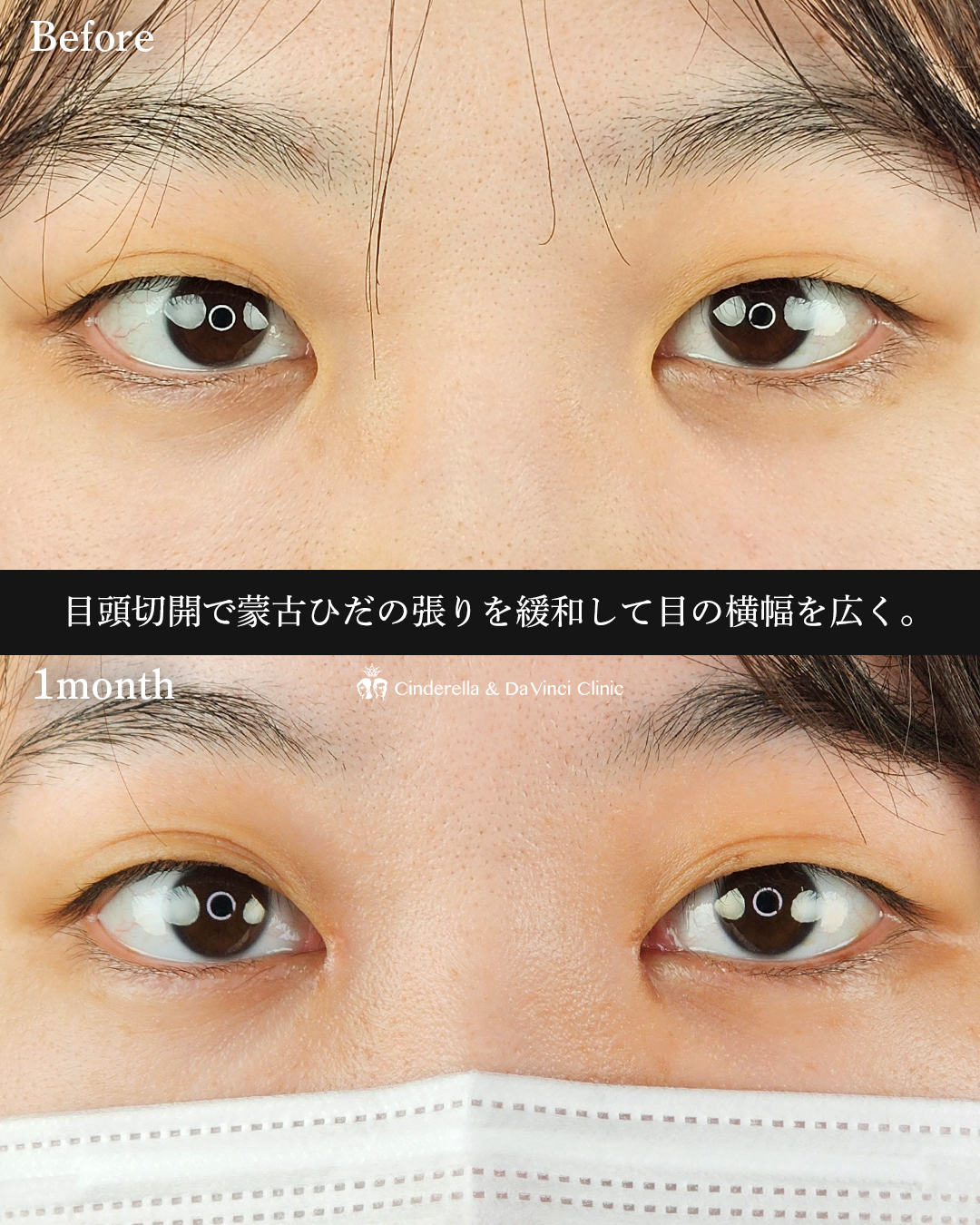 目頭切開のみの画像