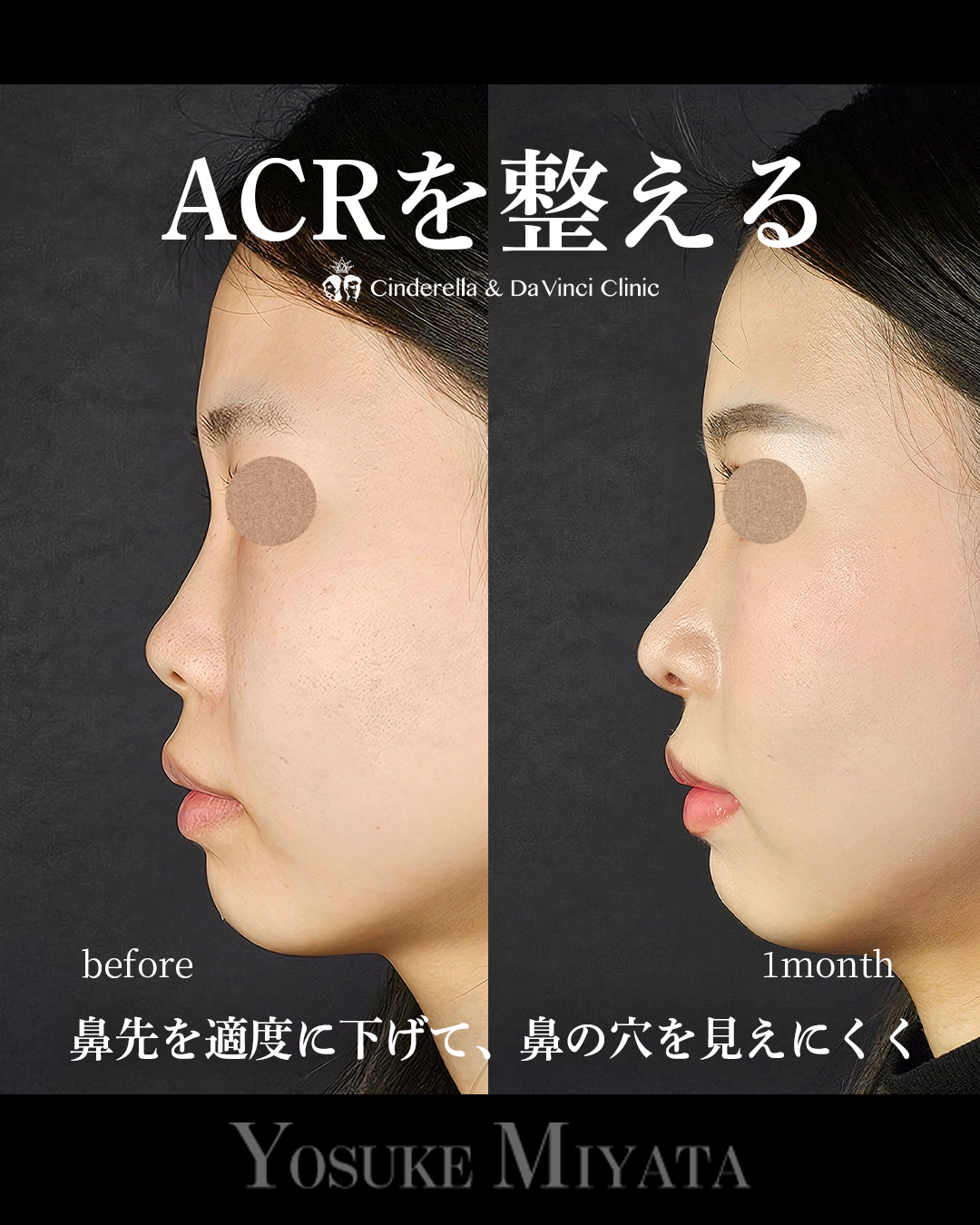 ACRを整えるの画像