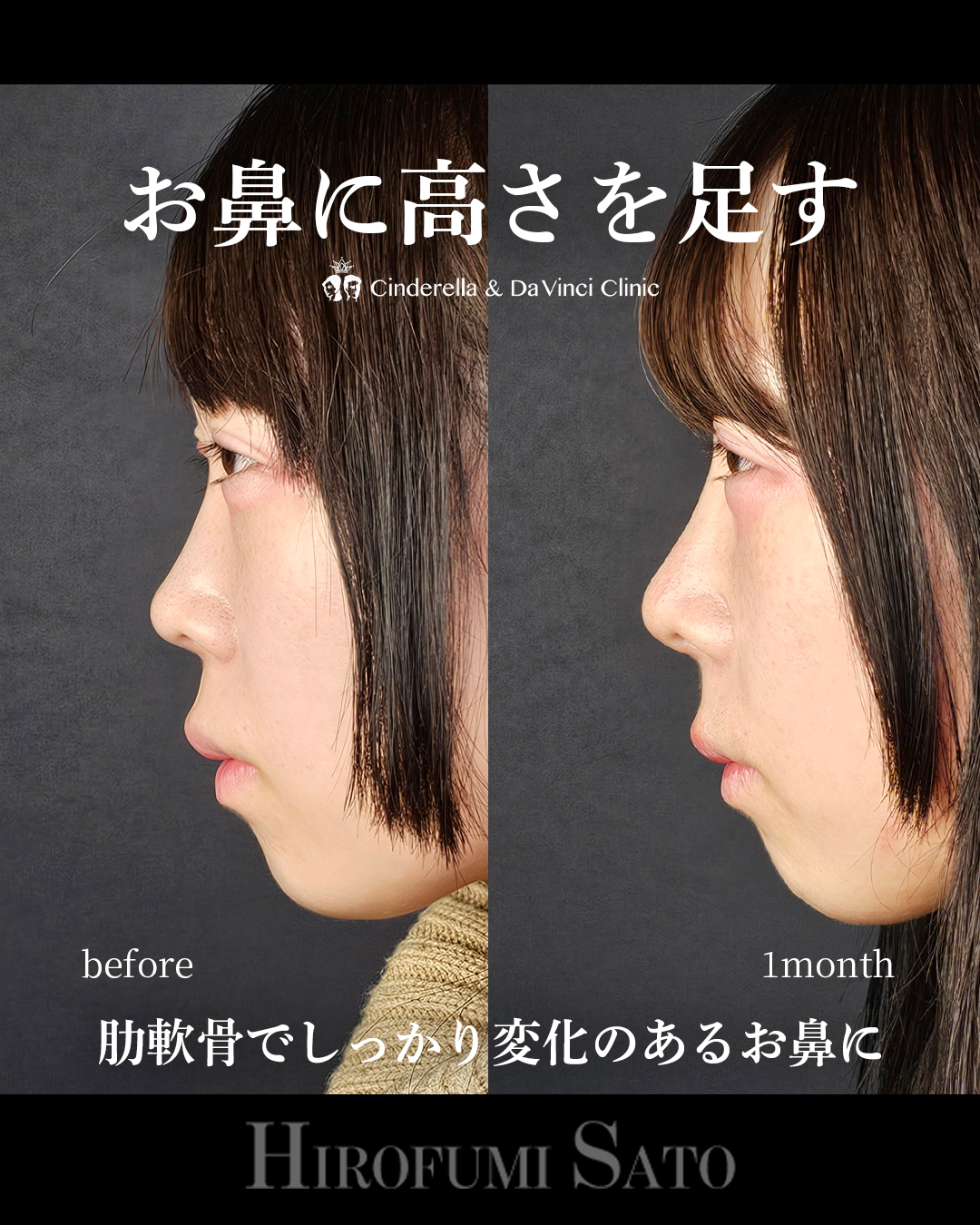 鼻に高さを足すの画像