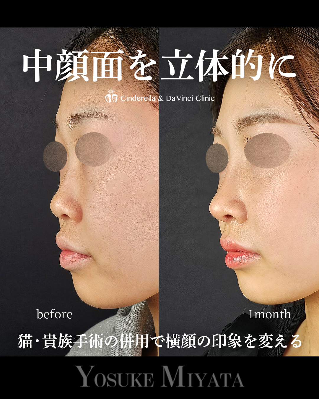 中顔面を立体的にの画像