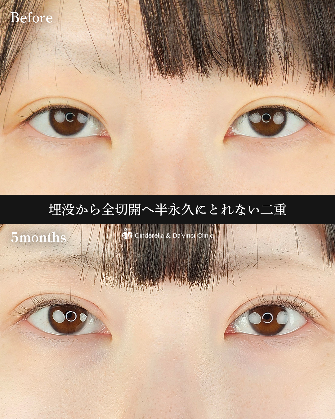 全切開法で華やか二重の画像