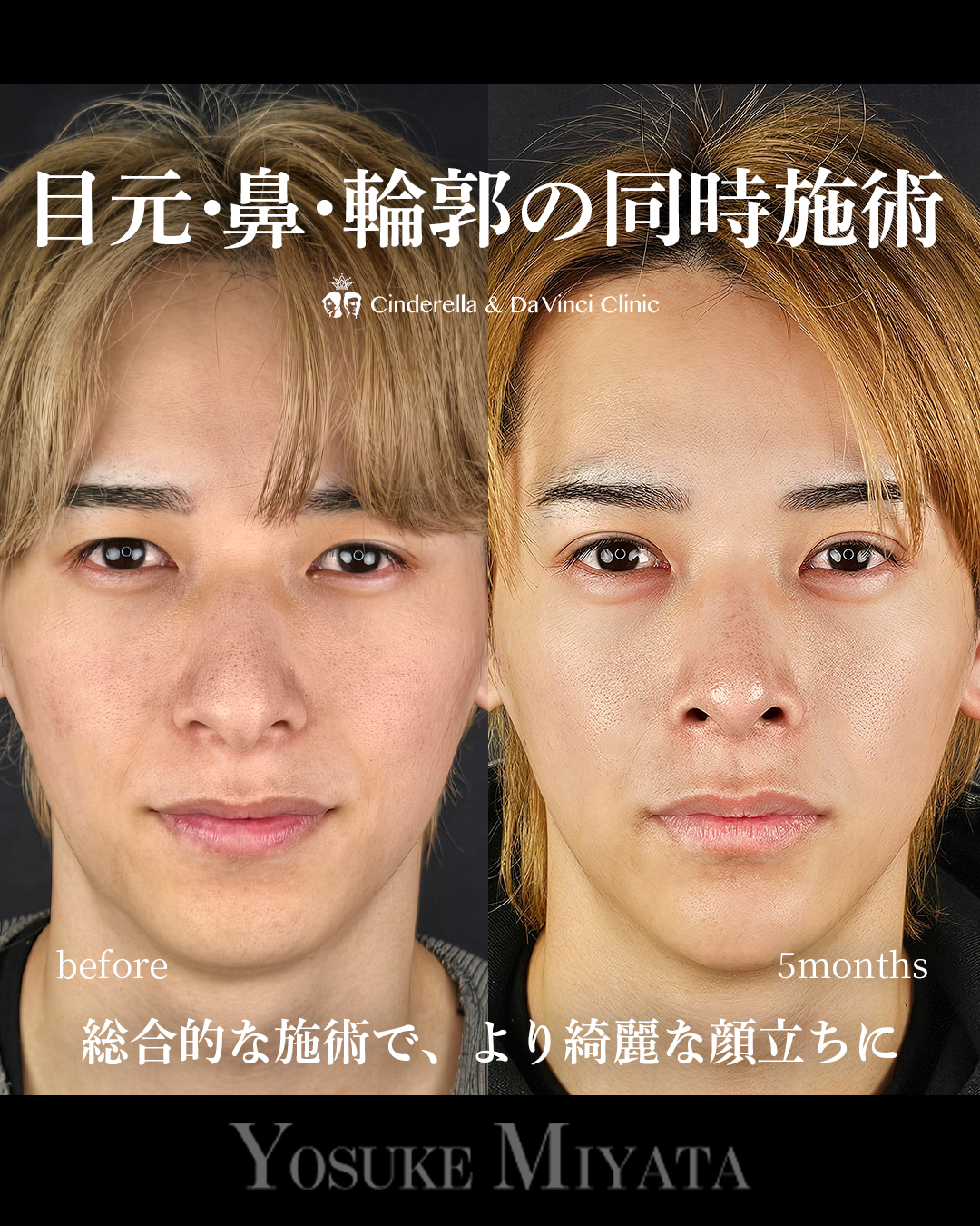 お顔全体アプデの画像