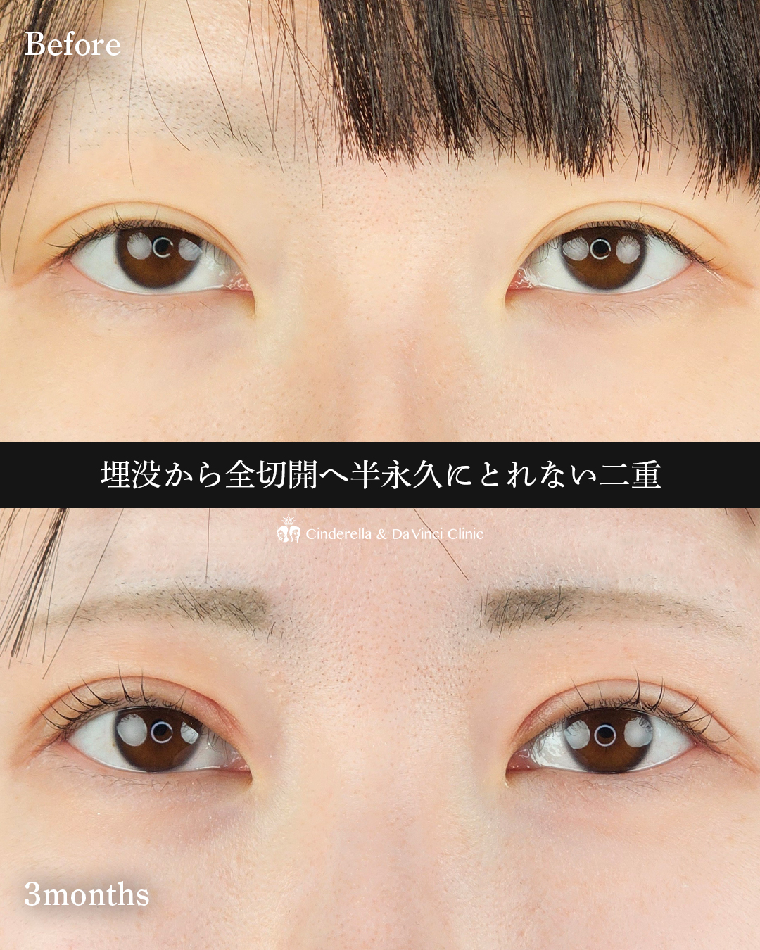 全切開法で華やか二重の画像