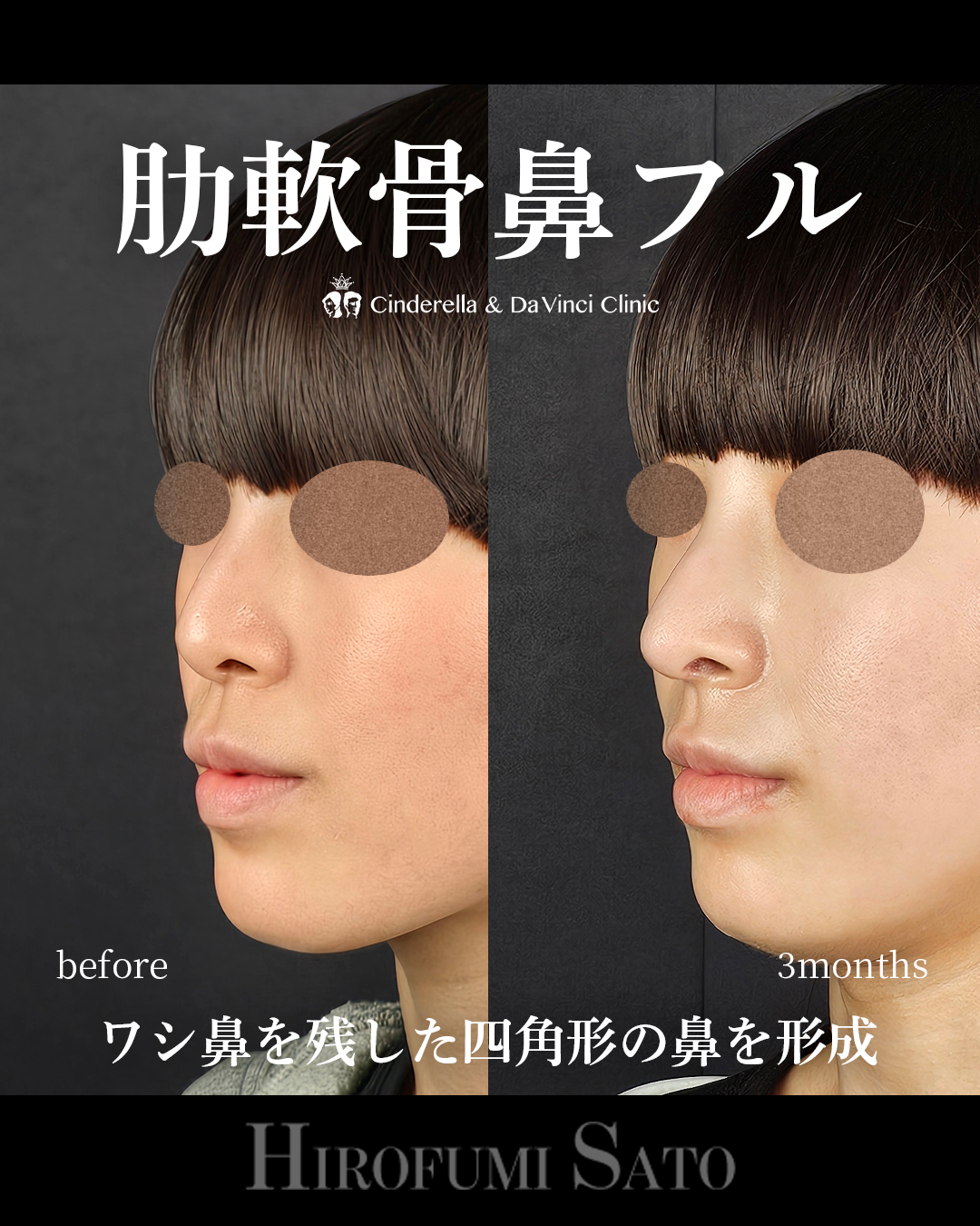 鷲鼻を残した鼻整形の画像