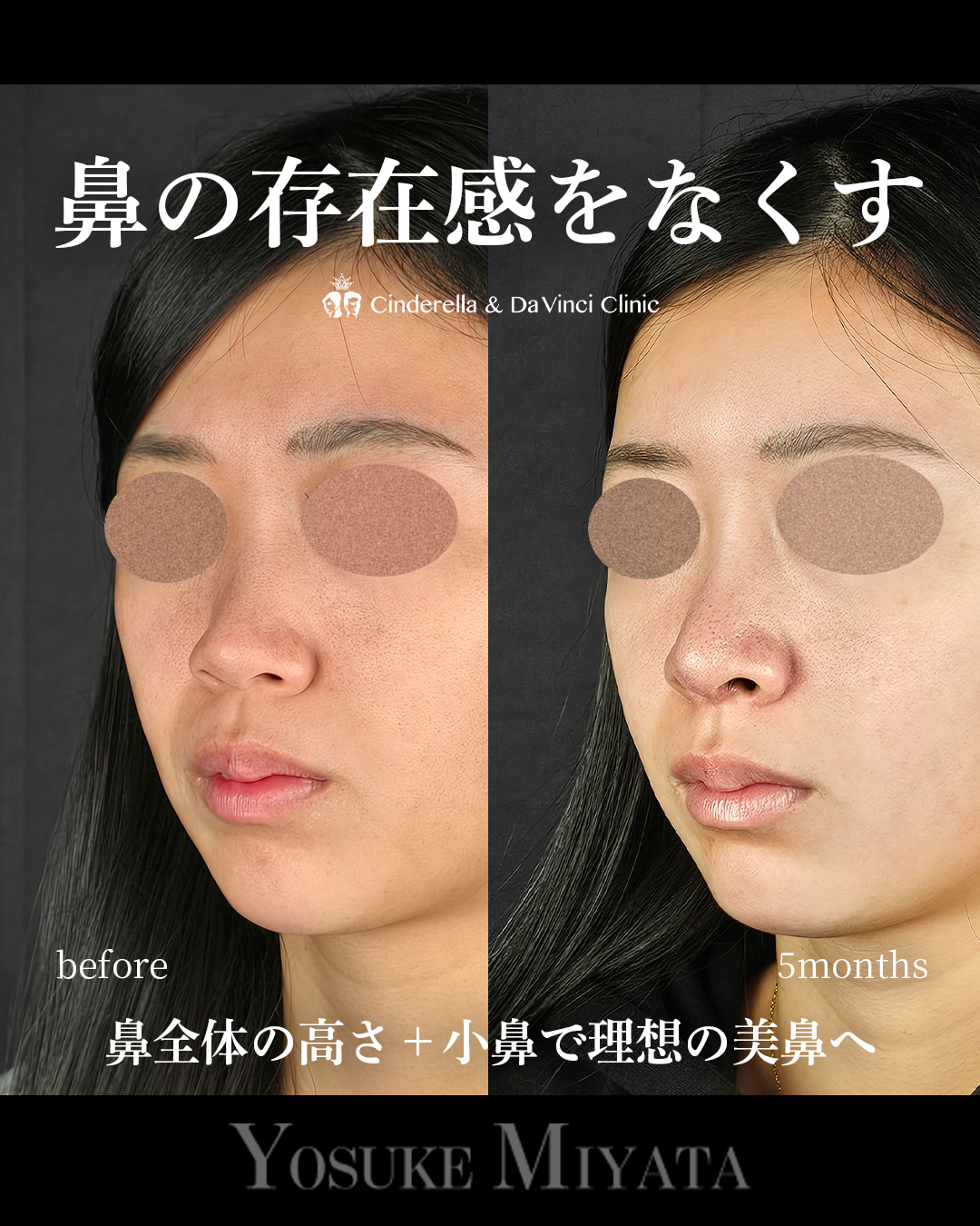 鼻の存在感をなくすの画像