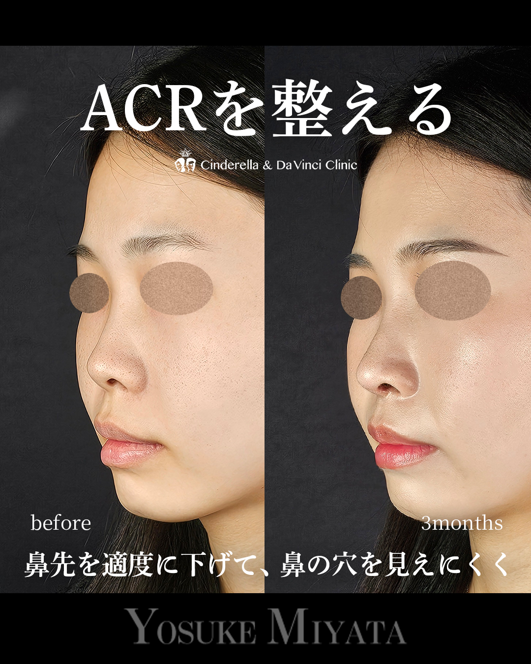 ACRを整えるの画像