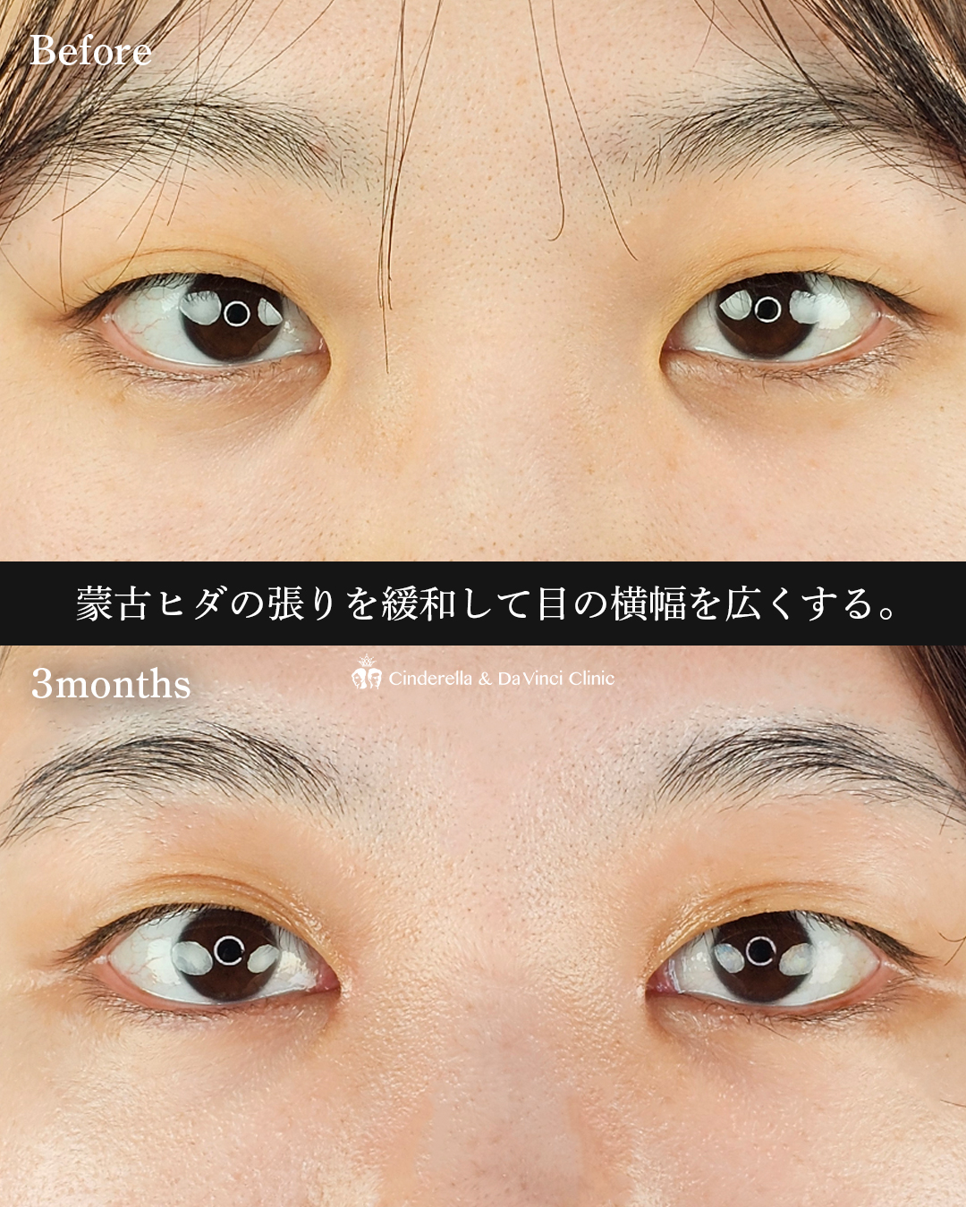 目頭切開のみの画像