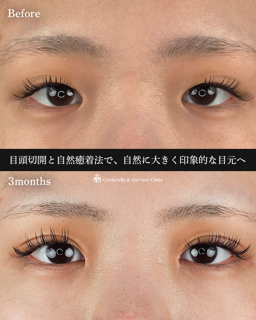 埋没と目頭同時手術の画像
