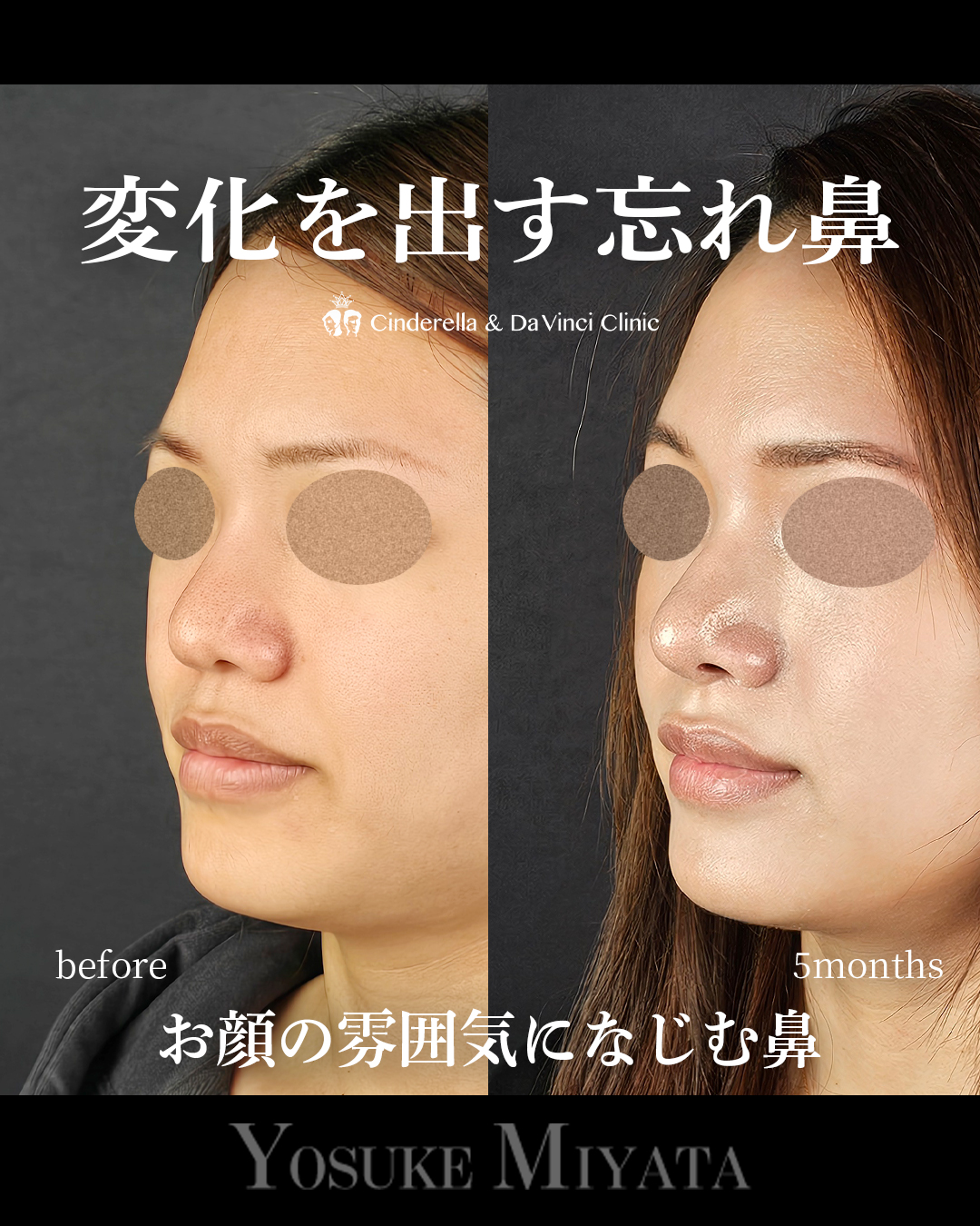 ナチュラルな忘れ鼻の画像