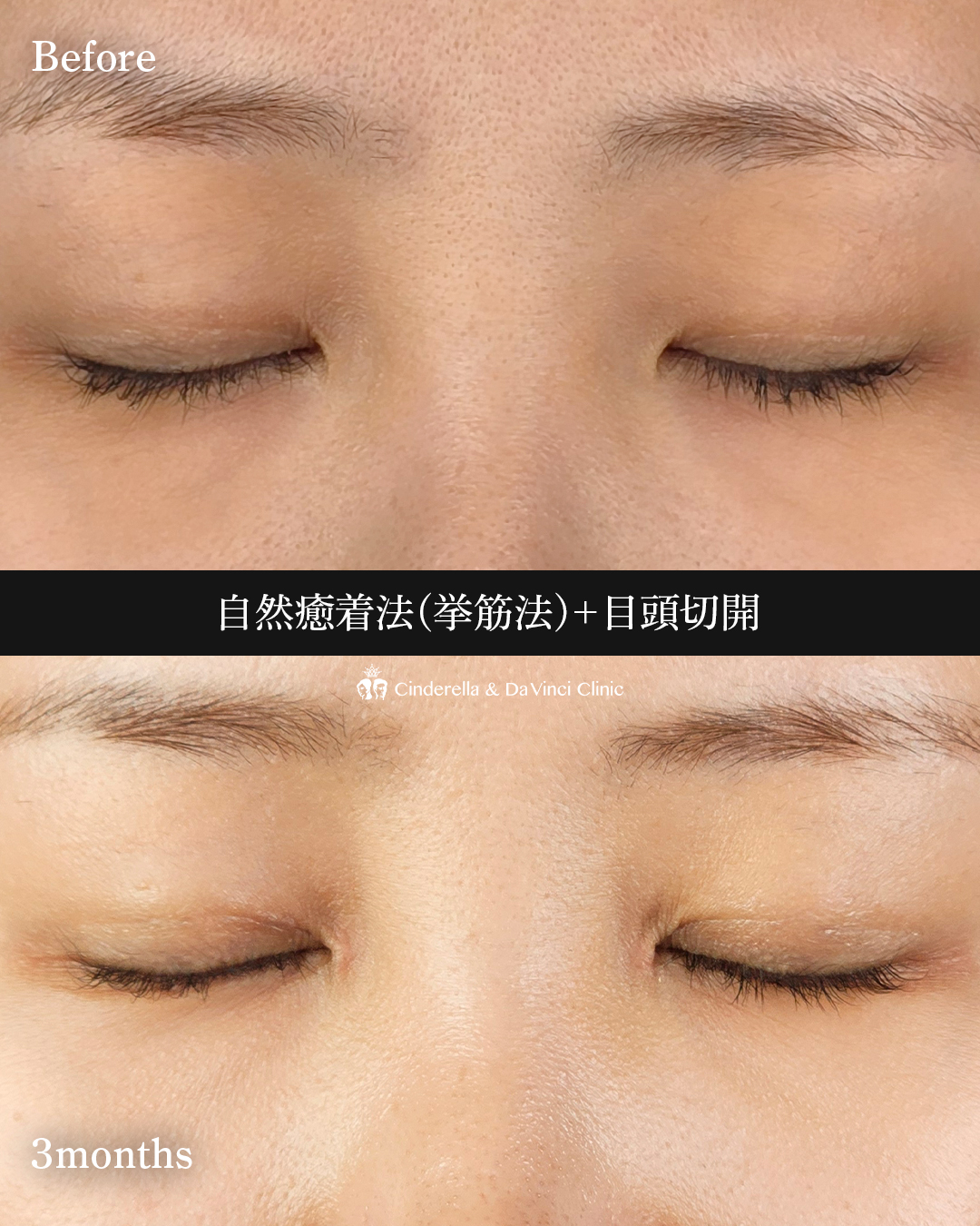 埋没×目頭の画像