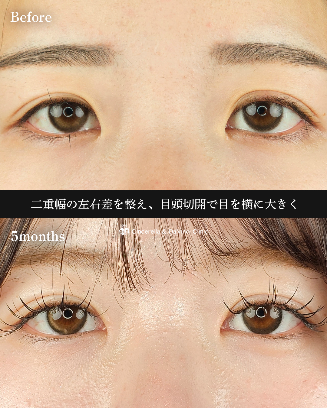 自然癒着法×目頭の画像