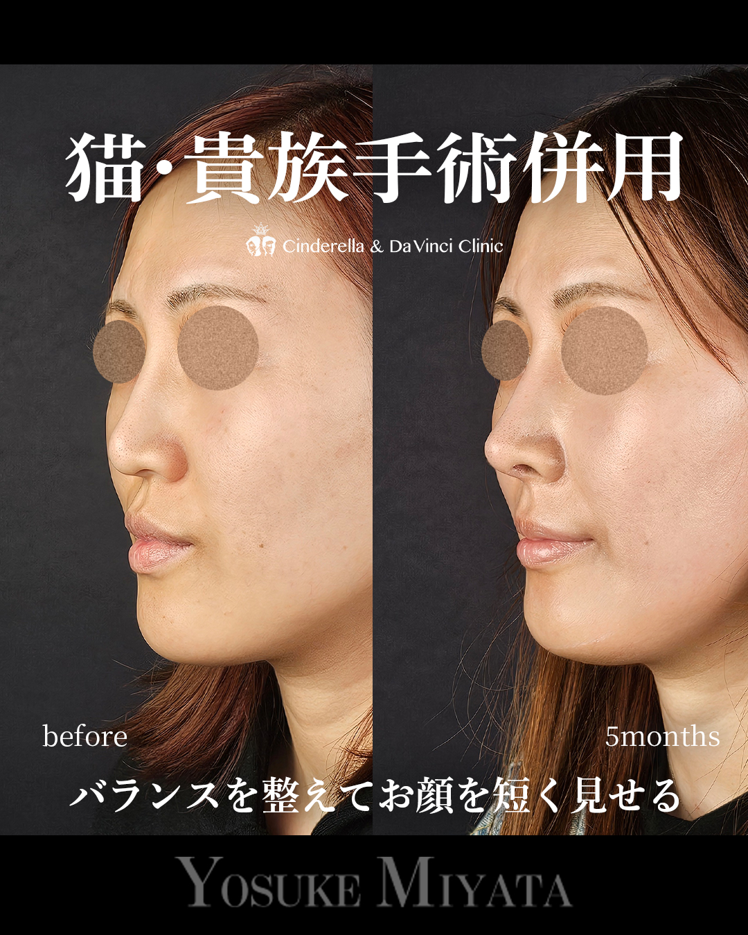 鼻整形で面長改善の画像