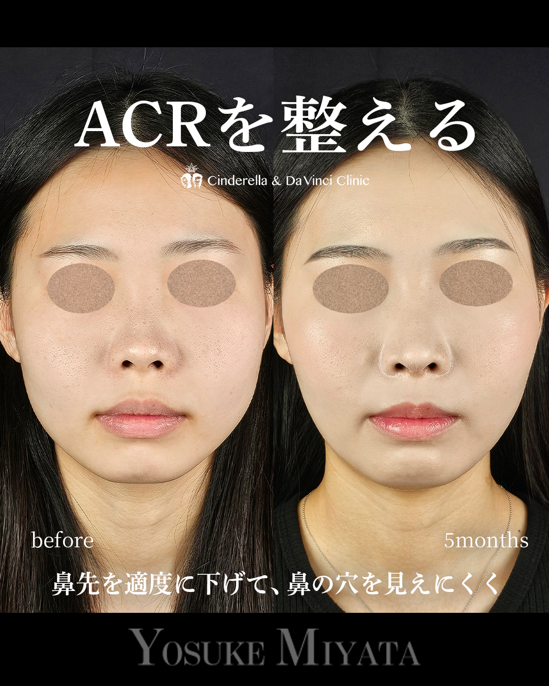 ACRを整えるの画像